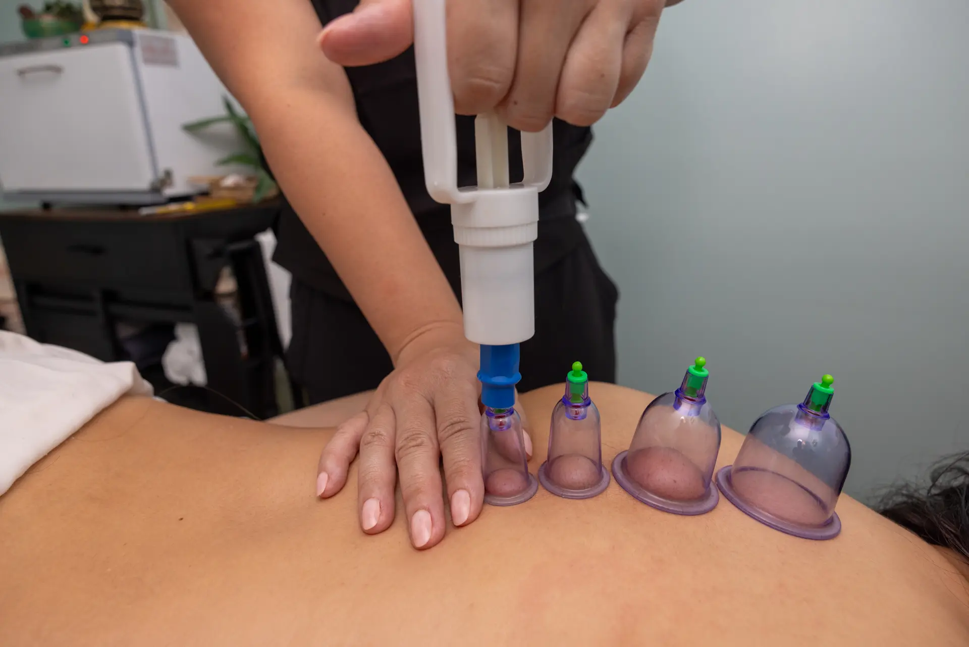 Cupping therapy on the upper back